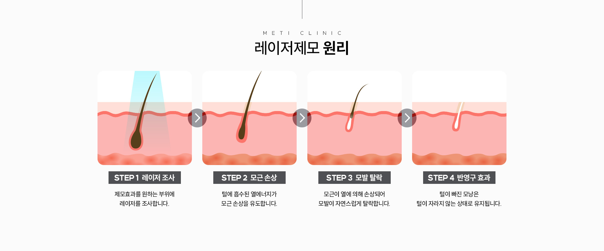 레이저제모 원리